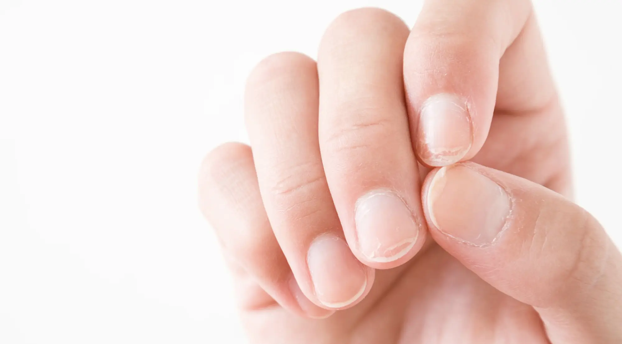 Cómo prevenir y eliminar las estrias en las uñas  Innatiacom